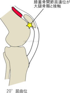 膝蓋軟骨遠位部と大腿骨顆の接触