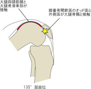 膝関節135°屈曲位における膝蓋軟骨の接触部位